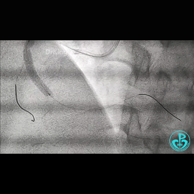 导丝怎么扩右冠近段弥漫性病变中远段闭塞顺利开通并植入支架，哪知道故事才刚刚开始！！！_https://www.jmylbn.com_新闻资讯_第7张