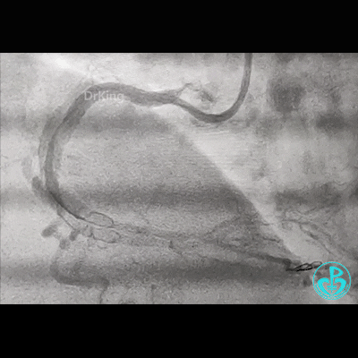 导丝怎么扩右冠近段弥漫性病变中远段闭塞顺利开通并植入支架，哪知道故事才刚刚开始！！！_https://www.jmylbn.com_新闻资讯_第12张