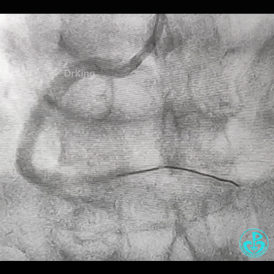 导丝怎么扩右冠近段弥漫性病变中远段闭塞顺利开通并植入支架，哪知道故事才刚刚开始！！！_https://www.jmylbn.com_新闻资讯_第22张