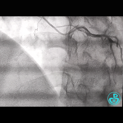 导丝怎么扩右冠近段弥漫性病变中远段闭塞顺利开通并植入支架，哪知道故事才刚刚开始！！！_https://www.jmylbn.com_新闻资讯_第2张