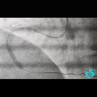 导丝怎么扩右冠近段弥漫性病变中远段闭塞顺利开通并植入支架，哪知道故事才刚刚开始！！！_https://www.jmylbn.com_新闻资讯_第18张