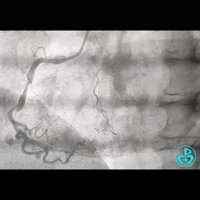导丝怎么扩右冠近段弥漫性病变中远段闭塞顺利开通并植入支架，哪知道故事才刚刚开始！！！_https://www.jmylbn.com_新闻资讯_第3张