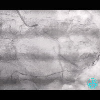 导丝怎么扩右冠近段弥漫性病变中远段闭塞顺利开通并植入支架，哪知道故事才刚刚开始！！！_https://www.jmylbn.com_新闻资讯_第1张