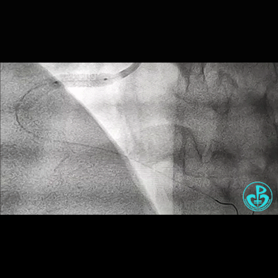 导丝怎么扩右冠近段弥漫性病变中远段闭塞顺利开通并植入支架，哪知道故事才刚刚开始！！！_https://www.jmylbn.com_新闻资讯_第25张