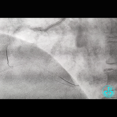 导丝怎么扩右冠近段弥漫性病变中远段闭塞顺利开通并植入支架，哪知道故事才刚刚开始！！！_https://www.jmylbn.com_新闻资讯_第5张
