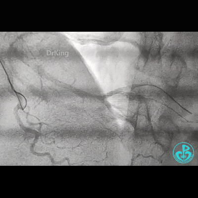 导丝怎么扩右冠近段弥漫性病变中远段闭塞顺利开通并植入支架，哪知道故事才刚刚开始！！！_https://www.jmylbn.com_新闻资讯_第6张