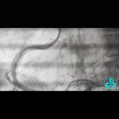 导丝怎么扩右冠近段弥漫性病变中远段闭塞顺利开通并植入支架，哪知道故事才刚刚开始！！！_https://www.jmylbn.com_新闻资讯_第27张