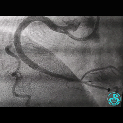 导丝怎么扩右冠近段弥漫性病变中远段闭塞顺利开通并植入支架，哪知道故事才刚刚开始！！！_https://www.jmylbn.com_新闻资讯_第21张