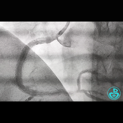 导丝怎么扩右冠近段弥漫性病变中远段闭塞顺利开通并植入支架，哪知道故事才刚刚开始！！！_https://www.jmylbn.com_新闻资讯_第24张
