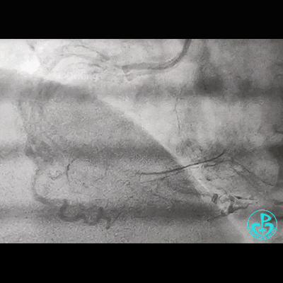 导丝怎么扩右冠近段弥漫性病变中远段闭塞顺利开通并植入支架，哪知道故事才刚刚开始！！！_https://www.jmylbn.com_新闻资讯_第10张