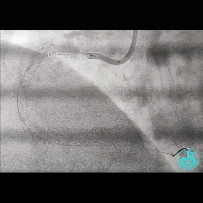 导丝怎么扩右冠近段弥漫性病变中远段闭塞顺利开通并植入支架，哪知道故事才刚刚开始！！！_https://www.jmylbn.com_新闻资讯_第13张