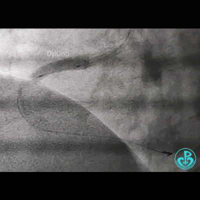 导丝怎么扩右冠近段弥漫性病变中远段闭塞顺利开通并植入支架，哪知道故事才刚刚开始！！！_https://www.jmylbn.com_新闻资讯_第20张