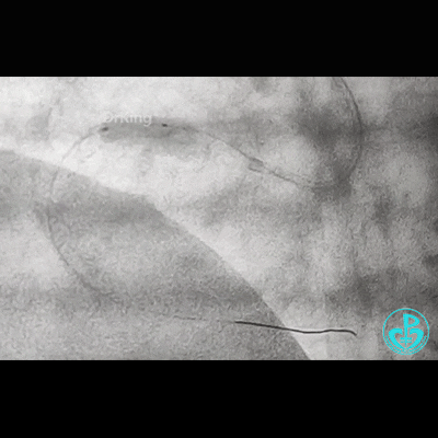 导丝怎么扩右冠近段弥漫性病变中远段闭塞顺利开通并植入支架，哪知道故事才刚刚开始！！！_https://www.jmylbn.com_新闻资讯_第16张