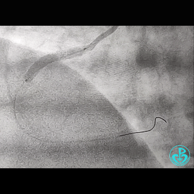 导丝怎么扩右冠近段弥漫性病变中远段闭塞顺利开通并植入支架，哪知道故事才刚刚开始！！！_https://www.jmylbn.com_新闻资讯_第9张