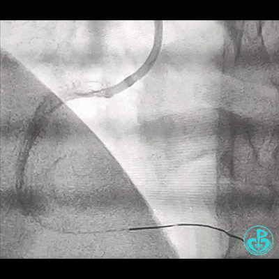 导丝怎么扩右冠近段弥漫性病变中远段闭塞顺利开通并植入支架，哪知道故事才刚刚开始！！！_https://www.jmylbn.com_新闻资讯_第23张