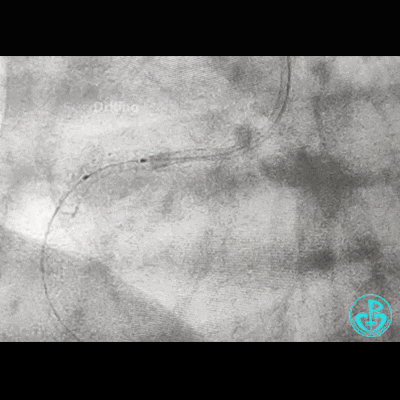 导丝怎么扩右冠近段弥漫性病变中远段闭塞顺利开通并植入支架，哪知道故事才刚刚开始！！！_https://www.jmylbn.com_新闻资讯_第17张