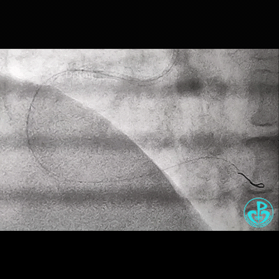 导丝怎么扩右冠近段弥漫性病变中远段闭塞顺利开通并植入支架，哪知道故事才刚刚开始！！！_https://www.jmylbn.com_新闻资讯_第14张