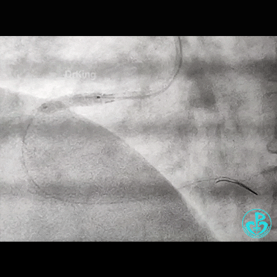 导丝怎么扩右冠近段弥漫性病变中远段闭塞顺利开通并植入支架，哪知道故事才刚刚开始！！！_https://www.jmylbn.com_新闻资讯_第15张