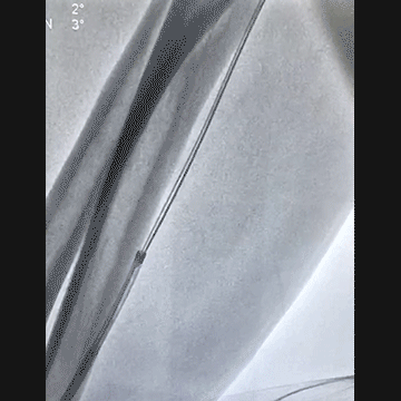 导丝怎么扩穿刺导丝跑到桡鞘外，导丝远端球囊扩张回拉入指引导管内取出_https://www.jmylbn.com_新闻资讯_第6张