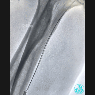 导丝怎么扩穿刺导丝跑到桡鞘外，导丝远端球囊扩张回拉入指引导管内取出_https://www.jmylbn.com_新闻资讯_第4张