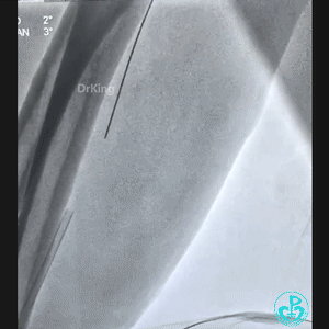 导丝怎么扩穿刺导丝跑到桡鞘外，导丝远端球囊扩张回拉入指引导管内取出_https://www.jmylbn.com_新闻资讯_第3张