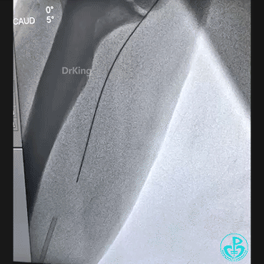导丝怎么扩穿刺导丝跑到桡鞘外，导丝远端球囊扩张回拉入指引导管内取出_https://www.jmylbn.com_新闻资讯_第1张