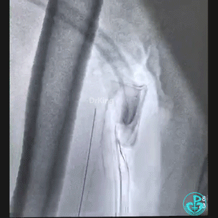 导丝怎么扩穿刺导丝跑到桡鞘外，导丝远端球囊扩张回拉入指引导管内取出_https://www.jmylbn.com_新闻资讯_第8张