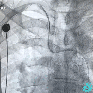 导丝怎么扩穿刺导丝跑到桡鞘外，导丝远端球囊扩张回拉入指引导管内取出_https://www.jmylbn.com_新闻资讯_第2张