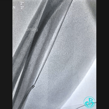 导丝怎么扩穿刺导丝跑到桡鞘外，导丝远端球囊扩张回拉入指引导管内取出_https://www.jmylbn.com_新闻资讯_第5张