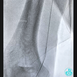 导丝怎么扩穿刺导丝跑到桡鞘外，导丝远端球囊扩张回拉入指引导管内取出_https://www.jmylbn.com_新闻资讯_第7张
