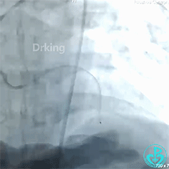 塞球囊怎么取左主干急性闭塞球囊扩张后反复室颤死亡，难道心脏破了？_https://www.jmylbn.com_新闻资讯_第4张