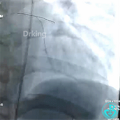 塞球囊怎么取左主干急性闭塞球囊扩张后反复室颤死亡，难道心脏破了？_https://www.jmylbn.com_新闻资讯_第3张