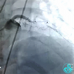 塞球囊怎么取左主干急性闭塞球囊扩张后反复室颤死亡，难道心脏破了？_https://www.jmylbn.com_新闻资讯_第2张