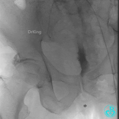 明胶在血管怎么降解并发症丨前降支CTO同侧逆向开通时侧支血管破裂，弹簧圈联合明胶海绵封堵_https://www.jmylbn.com_新闻资讯_第41张