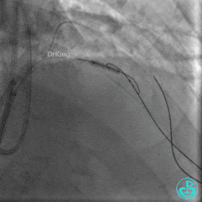 明胶在血管怎么降解并发症丨前降支CTO同侧逆向开通时侧支血管破裂，弹簧圈联合明胶海绵封堵_https://www.jmylbn.com_新闻资讯_第25张