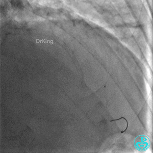 明胶在血管怎么降解并发症丨前降支CTO同侧逆向开通时侧支血管破裂，弹簧圈联合明胶海绵封堵_https://www.jmylbn.com_新闻资讯_第34张