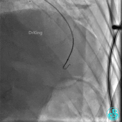 明胶在血管怎么降解并发症丨前降支CTO同侧逆向开通时侧支血管破裂，弹簧圈联合明胶海绵封堵_https://www.jmylbn.com_新闻资讯_第19张