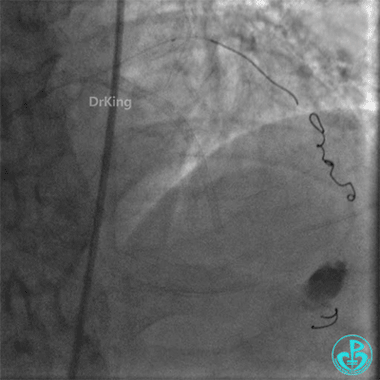 明胶在血管怎么降解并发症丨前降支CTO同侧逆向开通时侧支血管破裂，弹簧圈联合明胶海绵封堵_https://www.jmylbn.com_新闻资讯_第53张