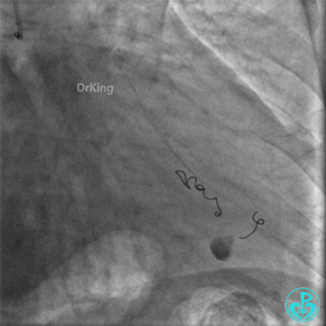 明胶在血管怎么降解并发症丨前降支CTO同侧逆向开通时侧支血管破裂，弹簧圈联合明胶海绵封堵_https://www.jmylbn.com_新闻资讯_第48张