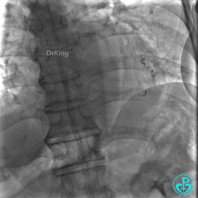 明胶在血管怎么降解并发症丨前降支CTO同侧逆向开通时侧支血管破裂，弹簧圈联合明胶海绵封堵_https://www.jmylbn.com_新闻资讯_第46张