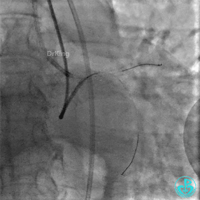 明胶在血管怎么降解并发症丨前降支CTO同侧逆向开通时侧支血管破裂，弹簧圈联合明胶海绵封堵_https://www.jmylbn.com_新闻资讯_第17张