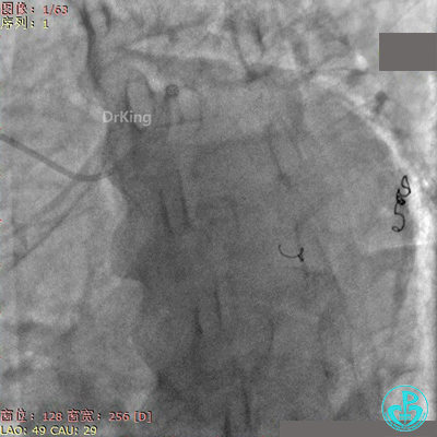 明胶在血管怎么降解并发症丨前降支CTO同侧逆向开通时侧支血管破裂，弹簧圈联合明胶海绵封堵_https://www.jmylbn.com_新闻资讯_第58张