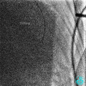 明胶在血管怎么降解并发症丨前降支CTO同侧逆向开通时侧支血管破裂，弹簧圈联合明胶海绵封堵_https://www.jmylbn.com_新闻资讯_第20张