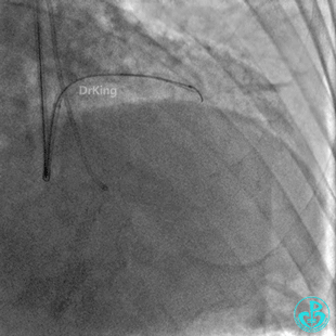 明胶在血管怎么降解并发症丨前降支CTO同侧逆向开通时侧支血管破裂，弹簧圈联合明胶海绵封堵_https://www.jmylbn.com_新闻资讯_第13张