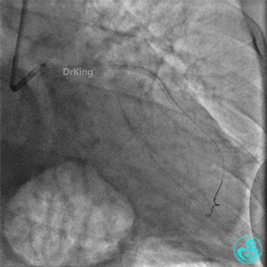 明胶在血管怎么降解并发症丨前降支CTO同侧逆向开通时侧支血管破裂，弹簧圈联合明胶海绵封堵_https://www.jmylbn.com_新闻资讯_第32张