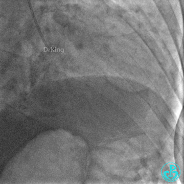 明胶在血管怎么降解并发症丨前降支CTO同侧逆向开通时侧支血管破裂，弹簧圈联合明胶海绵封堵_https://www.jmylbn.com_新闻资讯_第6张