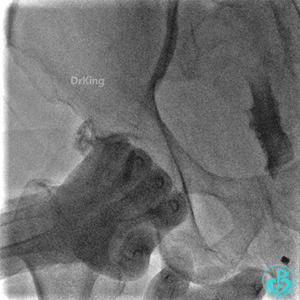 明胶在血管怎么降解并发症丨前降支CTO同侧逆向开通时侧支血管破裂，弹簧圈联合明胶海绵封堵_https://www.jmylbn.com_新闻资讯_第42张