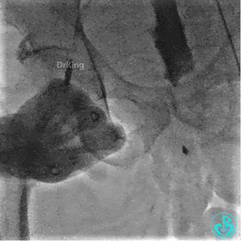 明胶在血管怎么降解并发症丨前降支CTO同侧逆向开通时侧支血管破裂，弹簧圈联合明胶海绵封堵_https://www.jmylbn.com_新闻资讯_第43张