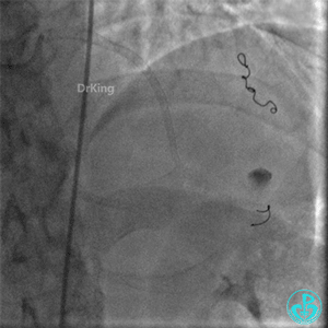 明胶在血管怎么降解并发症丨前降支CTO同侧逆向开通时侧支血管破裂，弹簧圈联合明胶海绵封堵_https://www.jmylbn.com_新闻资讯_第49张