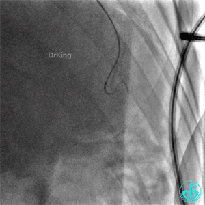 明胶在血管怎么降解并发症丨前降支CTO同侧逆向开通时侧支血管破裂，弹簧圈联合明胶海绵封堵_https://www.jmylbn.com_新闻资讯_第21张